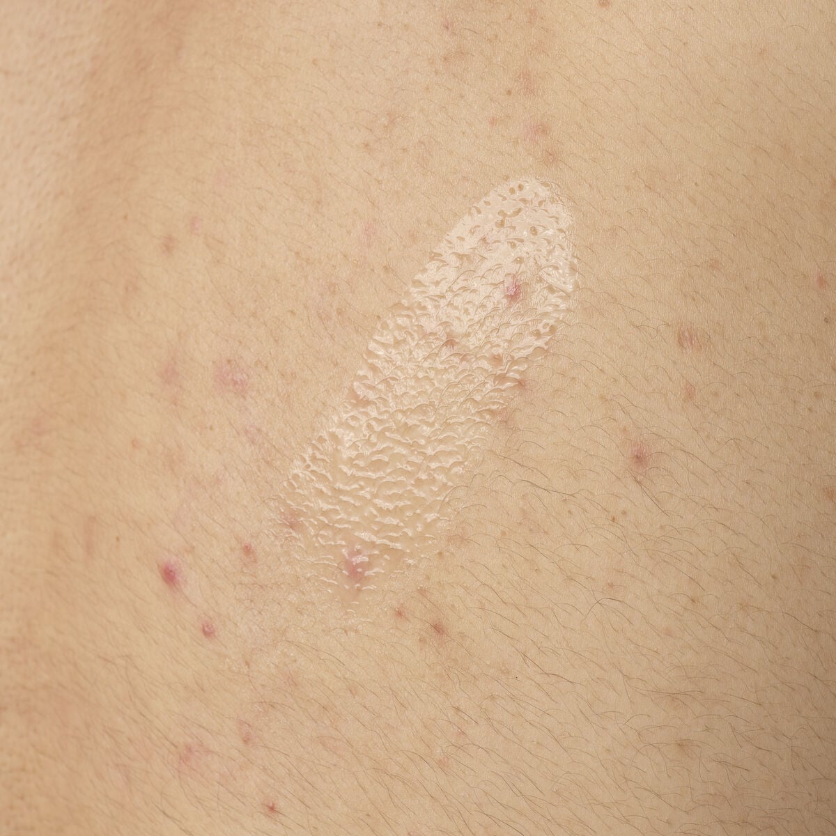 salicylic-acid-0-5-body-serum-l1 ORD-salicylic-acid-05-body-240ml-application.jpg