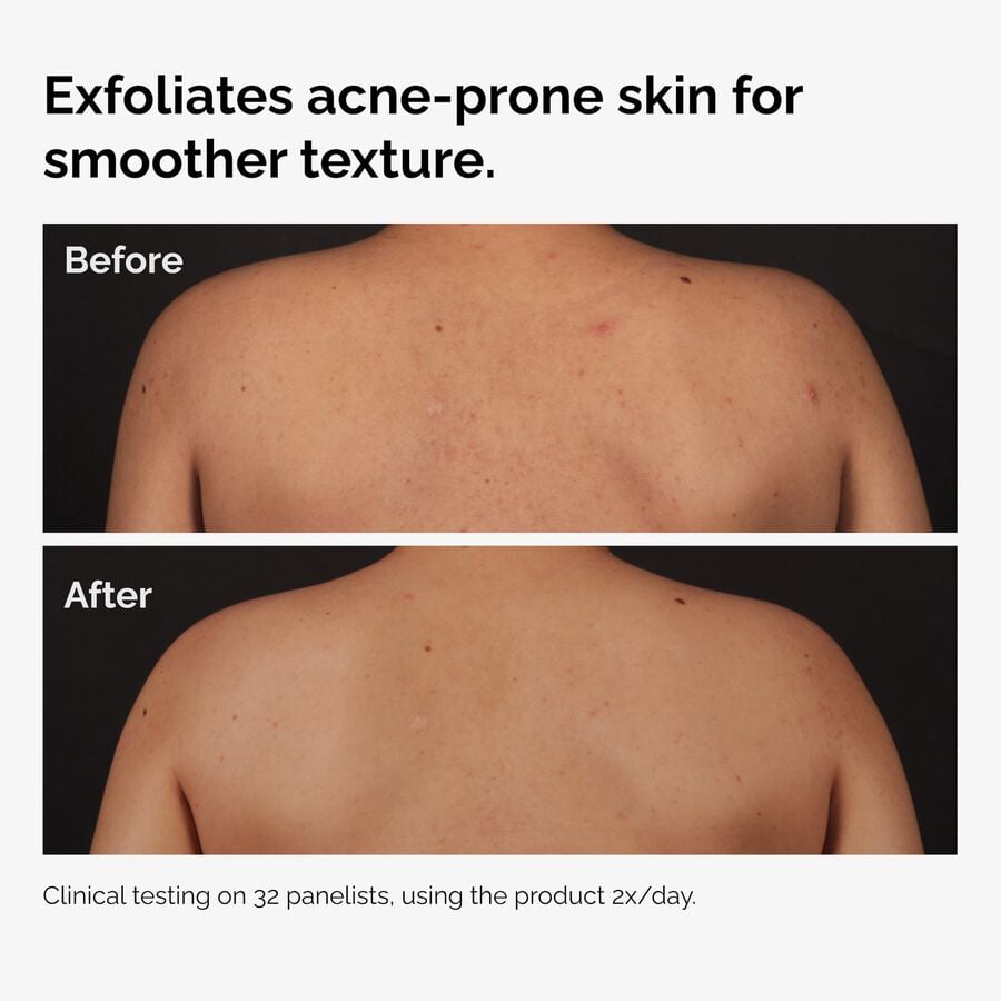 the-body-care-collection-t5 ord-salicylic-acid-body-serum-before-after-graphic-NA.jpg
